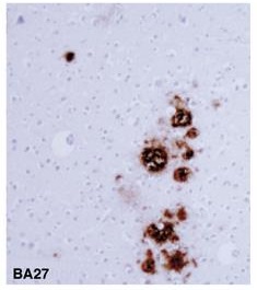 β淀粉样蛋白-免疫组织染色试剂盒                              Amyloid β-Protein Immunohistostain Kit